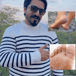 Portable USB Rechargeable Electric Callus Remover for Feet with Built in Vacuum Removes Dead Skin from Foot