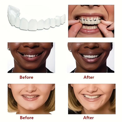 Snap On Smile Veneers Moldable False Artificial Braces Teeth Kits For Men And Women