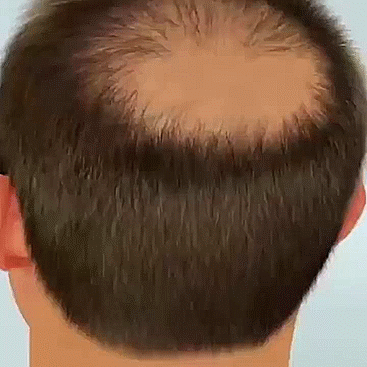 Imported Plant Fiber Applicator Treatment For Hair Growth For Men Health